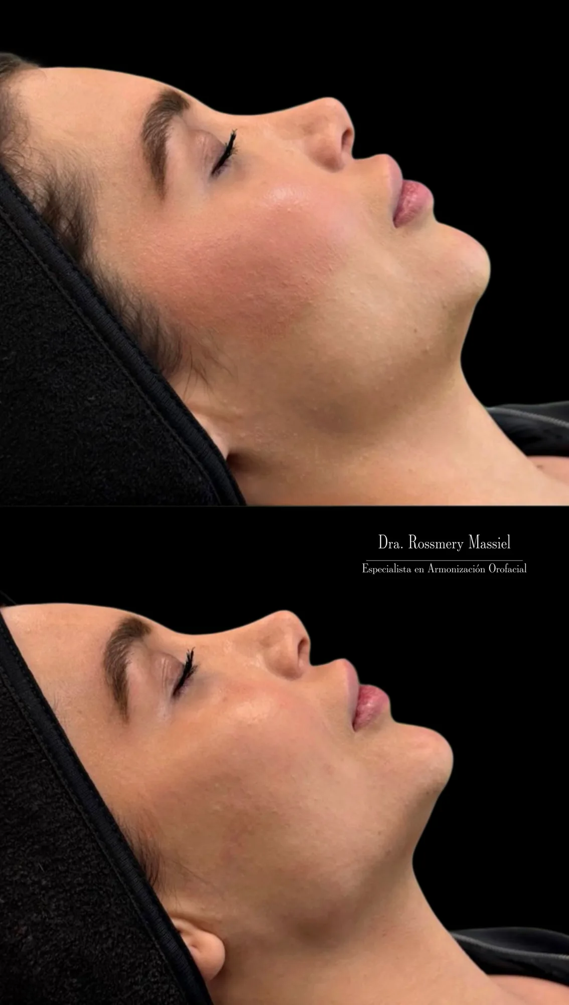 Fotografía clínica comparativa de armonización facial y contorno mandibular