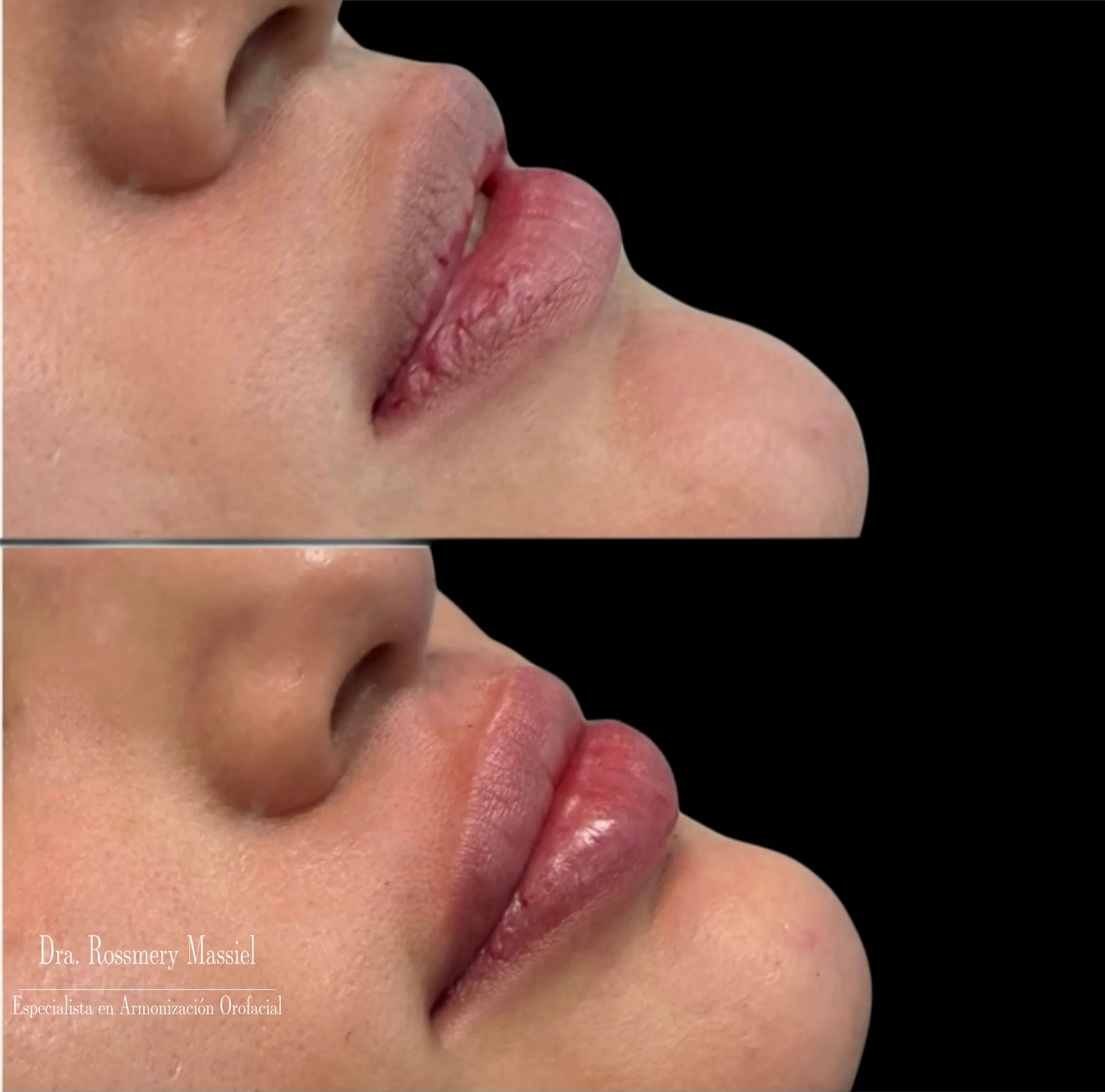 Fotografía clínica comparativa del perfil lateral de los labios