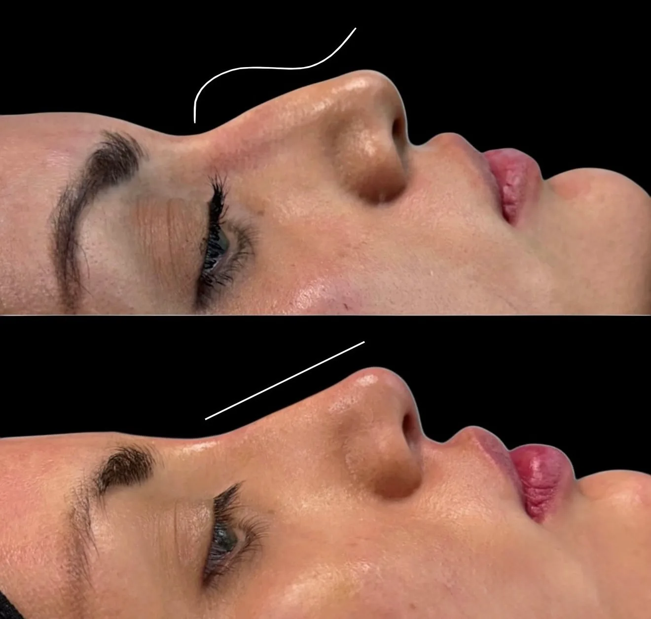 Fotografía clínica comparativa del perfil nasal después de una rinomodelación