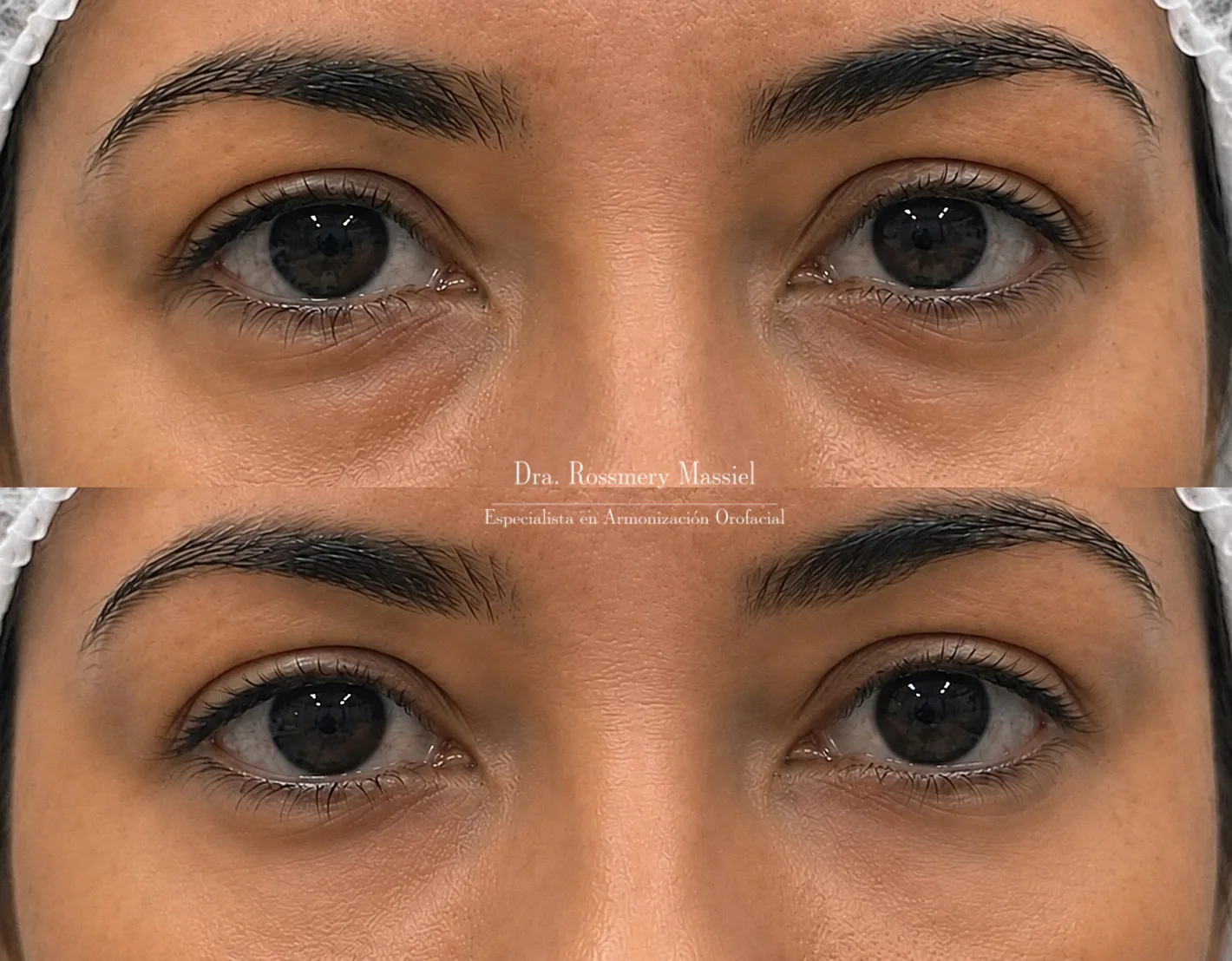 Fotografía clínica comparativa del contorno de ojos